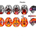 First MRI Scans Revealing How LSD Affects Our Brain