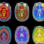 Neuroscientists are FREAKING OUT Over First MRI Scans Revealing How LSD Affects Our Brain!