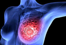 Scientists Amsterdam Destroyed Breast Cancer Tumors