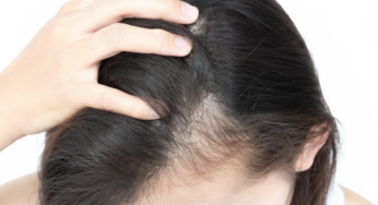 A Short Guide to Hair Loss and the Effect it Can Have on Your Mental Health